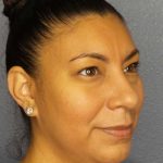 Liposuction of the Neck Before & After Patient #8286