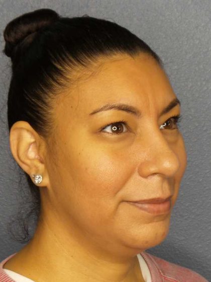 Liposuction of the Neck Before & After Patient #8286