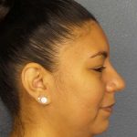Liposuction of the Neck Before & After Patient #8286