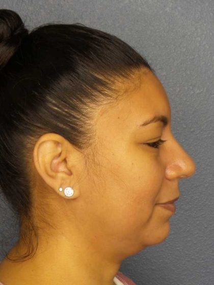 Liposuction of the Neck Before & After Patient #8286