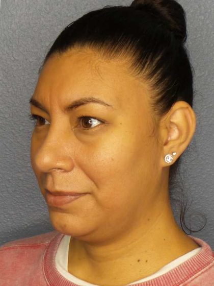 Liposuction of the Neck Before & After Patient #8286