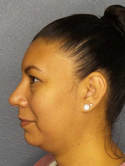 Liposuction of the Neck Before & After Patient #8286