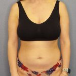 Brazilian Butt Lift Before & After Patient #4784