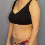 Brazilian Butt Lift Before & After Patient #4784