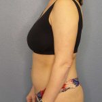 Brazilian Butt Lift Before & After Patient #4784