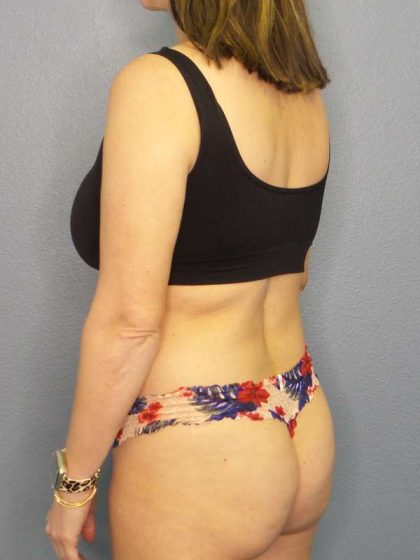 Brazilian Butt Lift Before & After Patient #4784