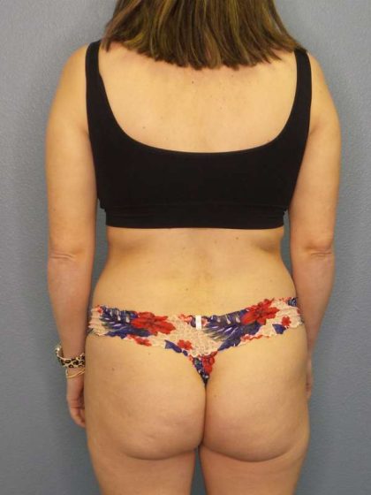 Brazilian Butt Lift Before & After Patient #4784