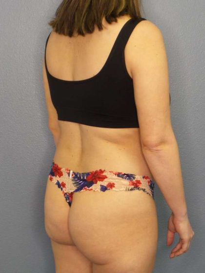 Brazilian Butt Lift Before & After Patient #4784