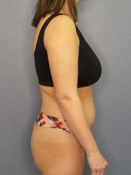 Brazilian Butt Lift Before & After Patient #4784