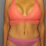 Abdominoplasty Before & After Patient #3797