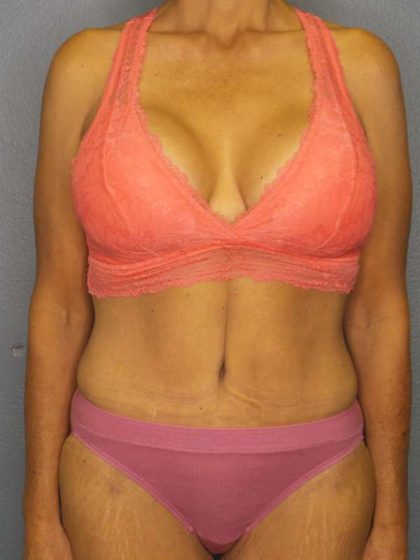 Abdominoplasty Before & After Patient #3797