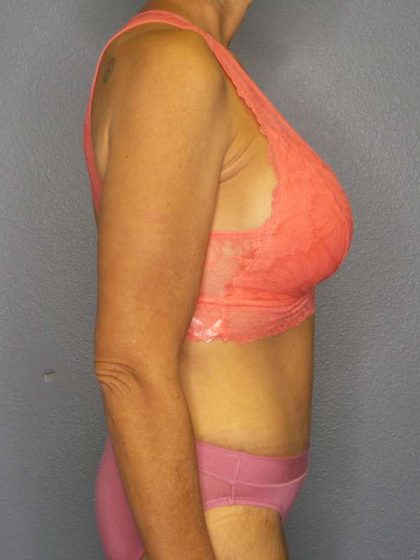 Abdominoplasty Before & After Patient #3797