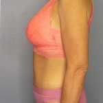 Abdominoplasty Before & After Patient #3797