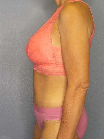 Abdominoplasty Before & After Patient #3797