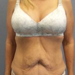 Abdominoplasty Before & After Patient #3797