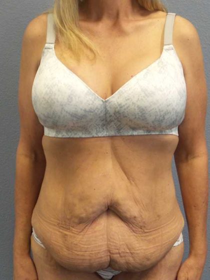 Abdominoplasty Before & After Patient #3797