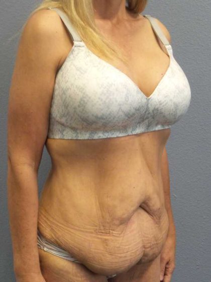 Abdominoplasty Before & After Patient #3797