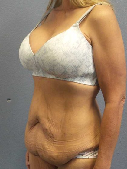 Abdominoplasty Before & After Patient #3797