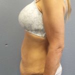 Abdominoplasty Before & After Patient #3797
