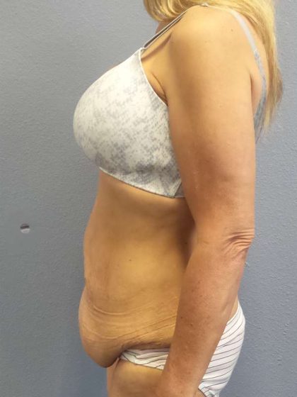 Abdominoplasty Before & After Patient #3797