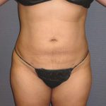 Liposuction Female Before & After Patient #7976