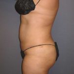 Liposuction Female Before & After Patient #7976