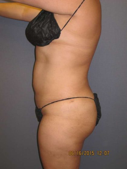 Liposuction Female Before & After Patient #7976