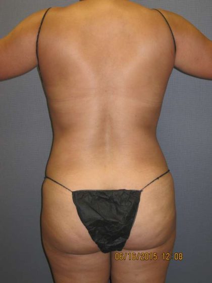 Liposuction Female Before & After Patient #7976