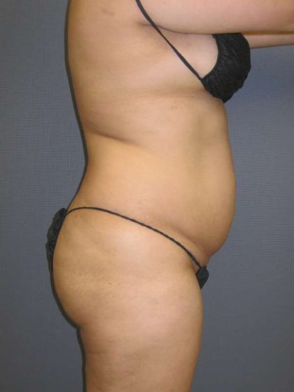 Liposuction Female Before & After Patient #7976