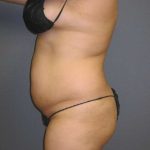 Liposuction Female Before & After Patient #7976