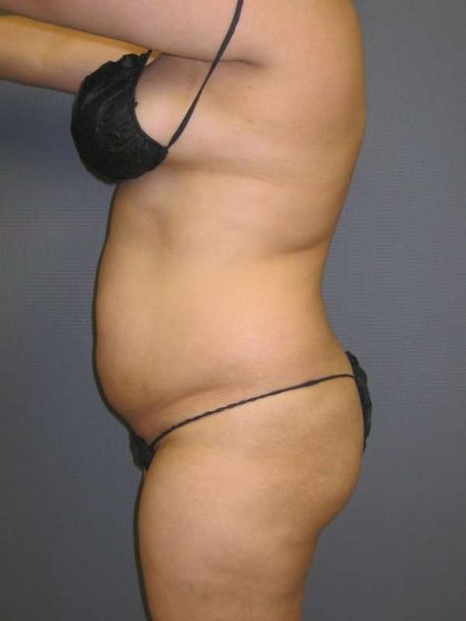 Liposuction Female Before & After Patient #7976