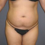 Liposuction Female Before & After Patient #7976