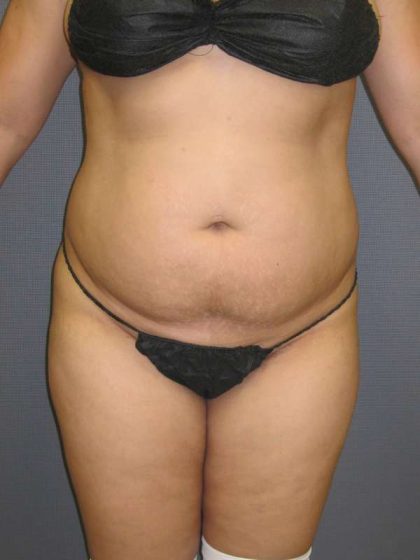 Liposuction Female Before & After Patient #7976