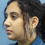 Rhinoplasty Before & After Patient #9980