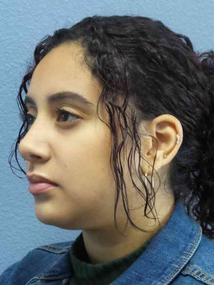 Rhinoplasty Before & After Patient #9980
