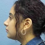 Rhinoplasty Before & After Patient #9980