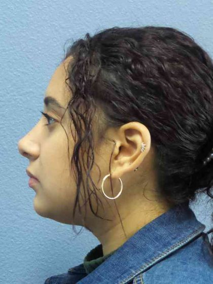 Rhinoplasty Before & After Patient #9980