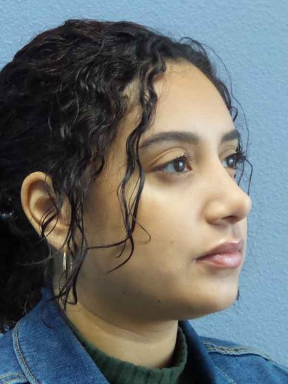 Rhinoplasty Before & After Patient #9980