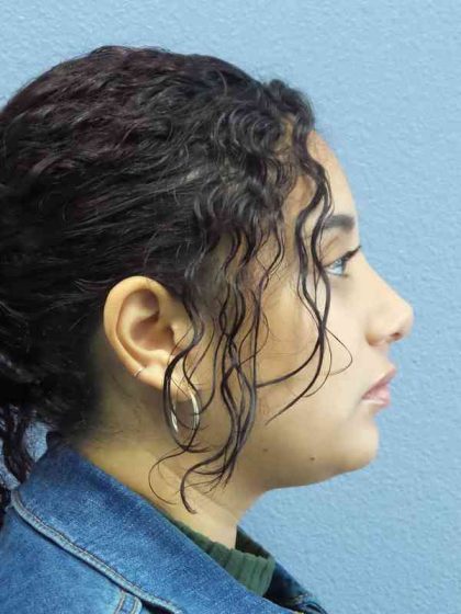 Rhinoplasty Before & After Patient #9980
