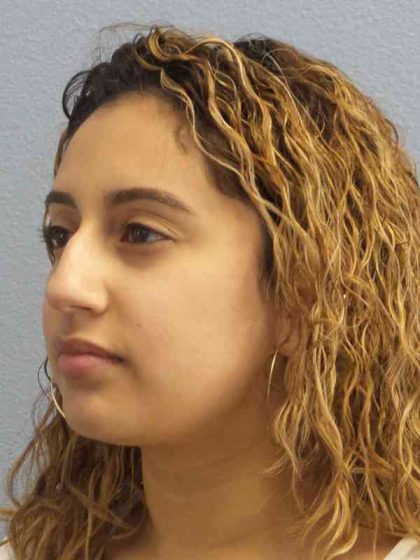 Rhinoplasty Before & After Patient #9980
