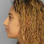Rhinoplasty Before & After Patient #9980