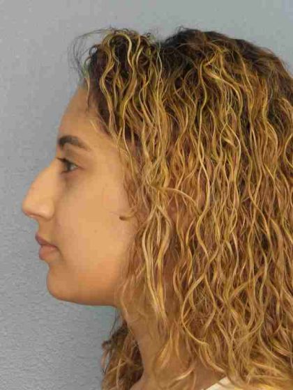 Rhinoplasty Before & After Patient #9980