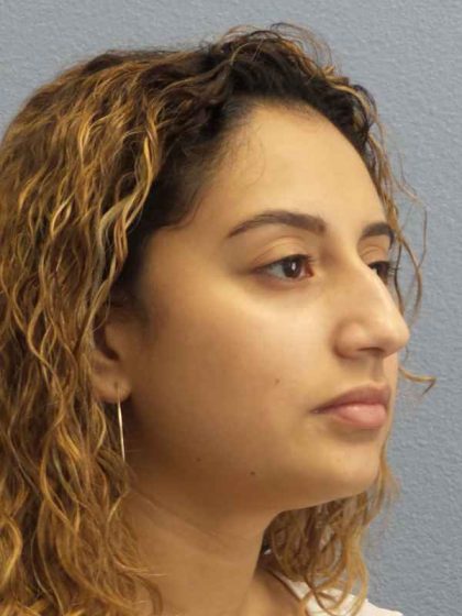 Rhinoplasty Before & After Patient #9980