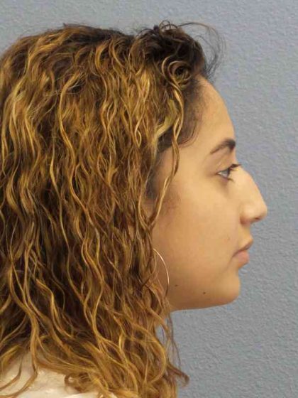 Rhinoplasty Before & After Patient #9980