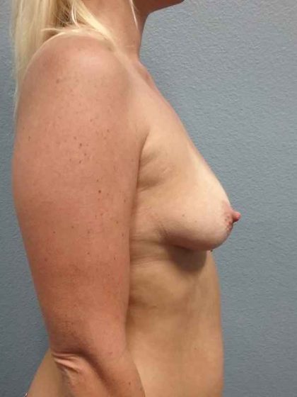 Breast Augmentation Before & After Patient #5685