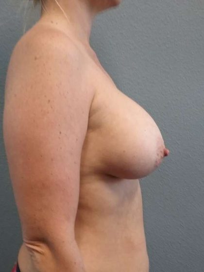 Breast Augmentation Before & After Patient #5685