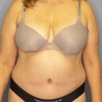 Abdominoplasty Before & After Patient #3692