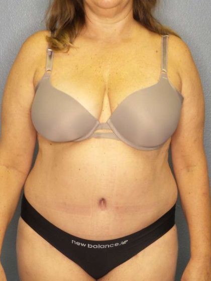 Abdominoplasty Before & After Patient #3692