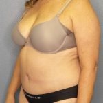 Abdominoplasty Before & After Patient #3692