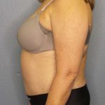 Abdominoplasty Before & After Patient #3692